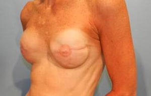 Patient with standard implants for reconstruction.