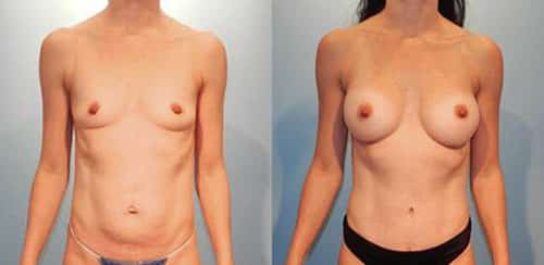Breast augmentation combined with abdominoplasty.