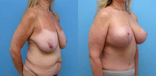 Structural mastopexy combined with abdominoplasty.