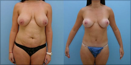 Mommy makeover before and after. Breast lift combined with high tension lateral abdominoplasty.