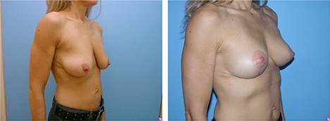 original_structural_mastopexy