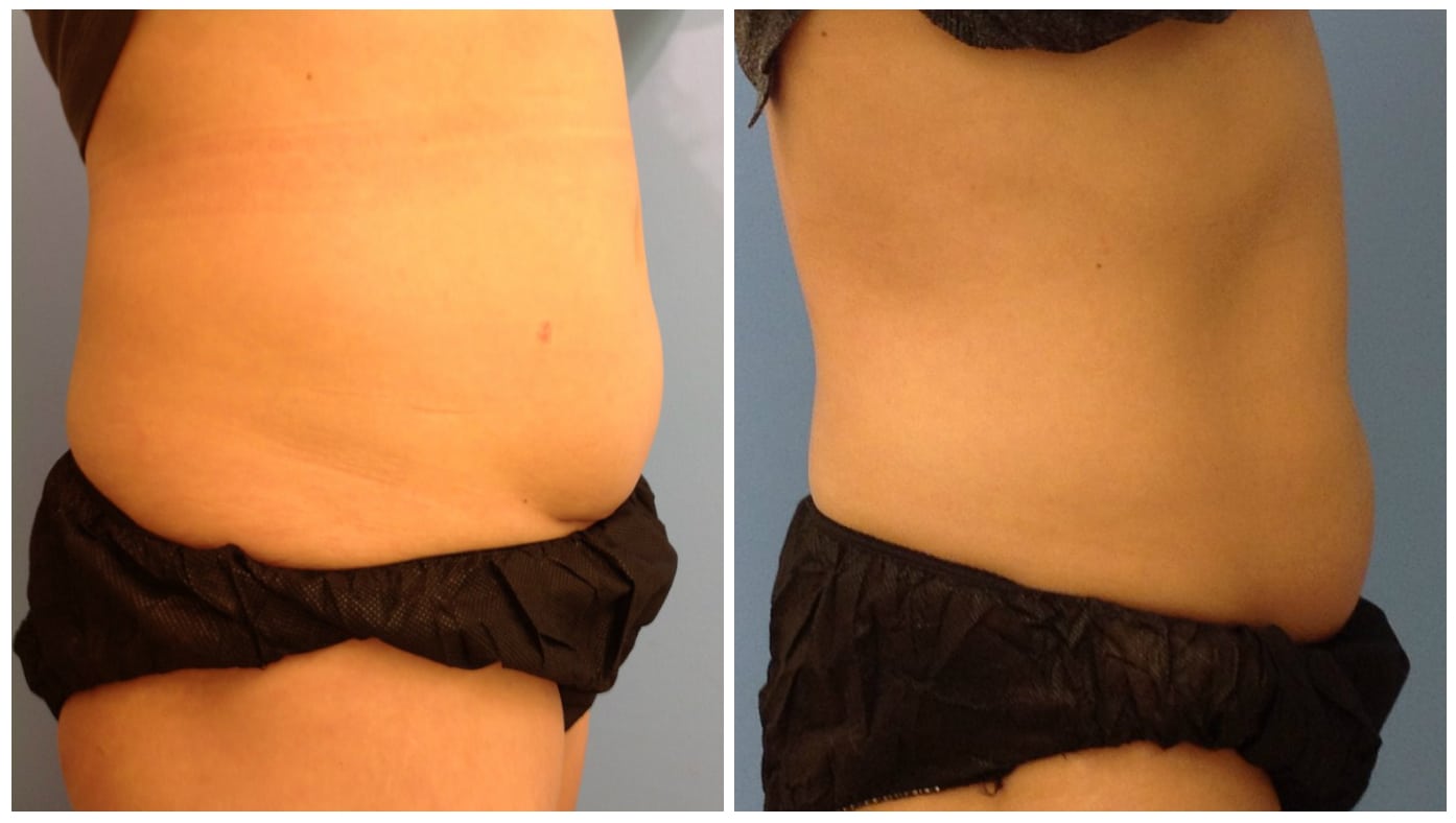 SculpSure before and after Chicago