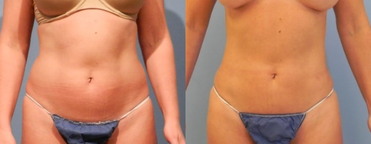 liposuction chicago