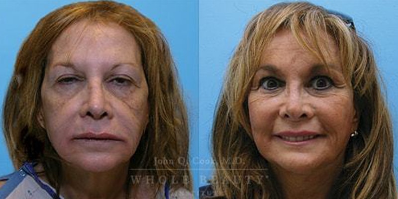 facelift-4 facelift