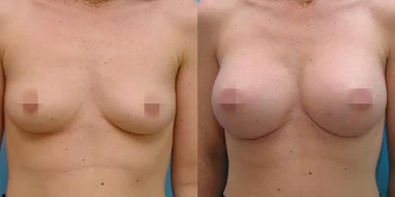 breastaug-1 breastaug