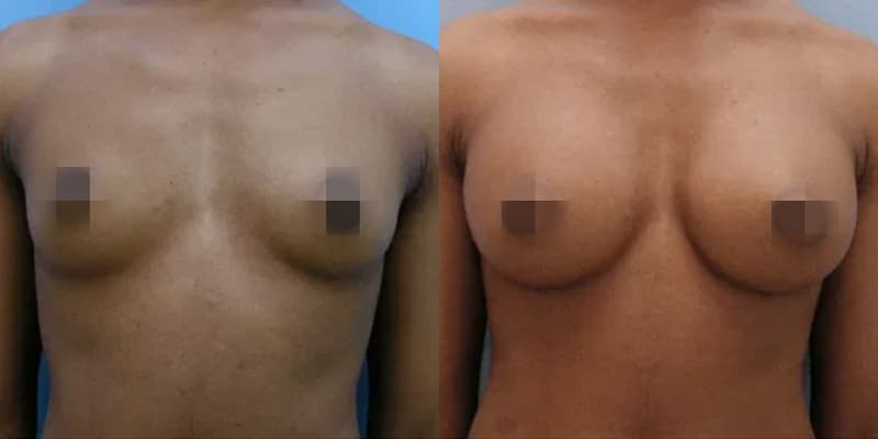 breastaug-2 breastaug