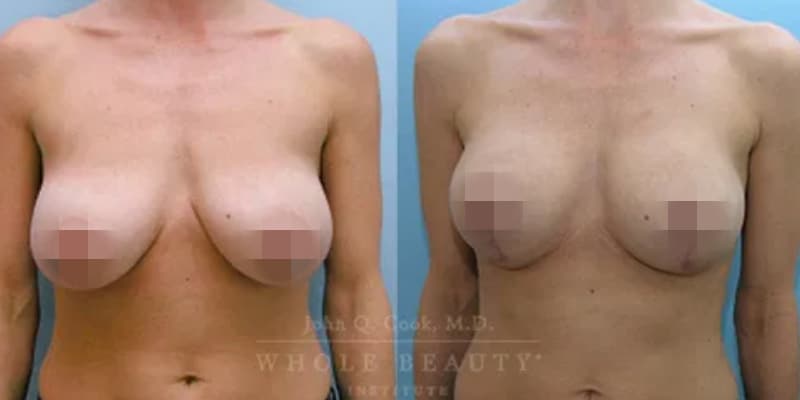 breastlift-2 breastlift