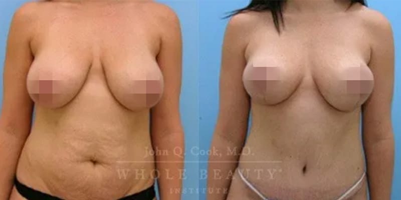breastlift-3 breastlift