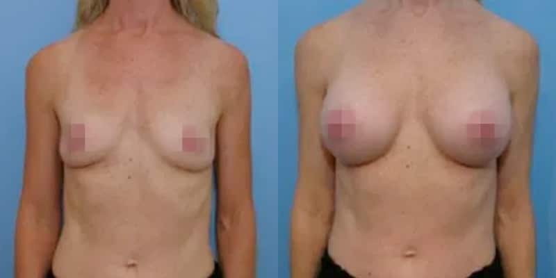 breastsug-3 breastsug