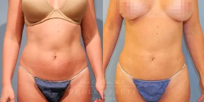 lipo-1 lipo