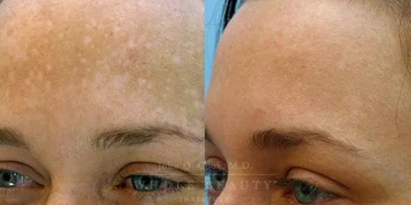 peel-ipl-2 peel ipl