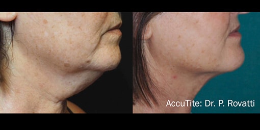 accutite-3 accutite