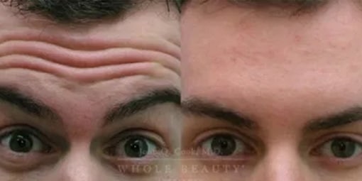 botox-2 botox