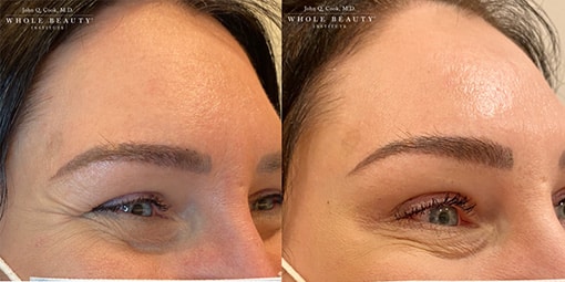 botox-3 botox