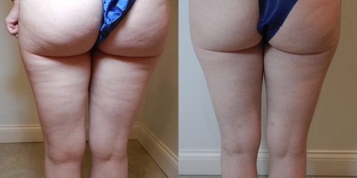 cellulaze-2 cellulaze