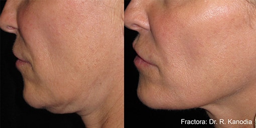 fractora-1 fractora