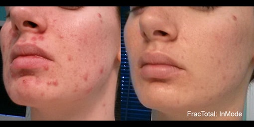 fractora-3 fractora