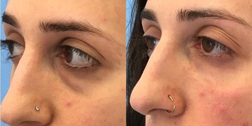 tear-trough-filler-1 tear trough filler