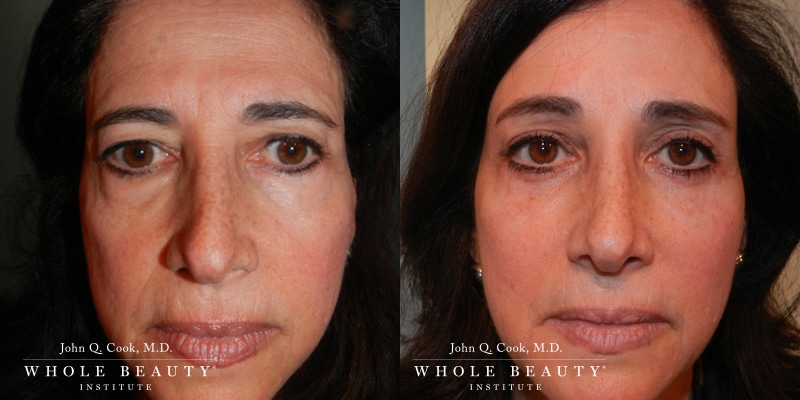 browlift-a browlift a