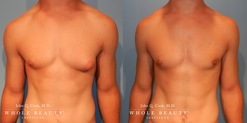 gynecomastia gynecomastia