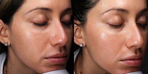 hydrafacial-microneedle-1 hydrafacial microneedle