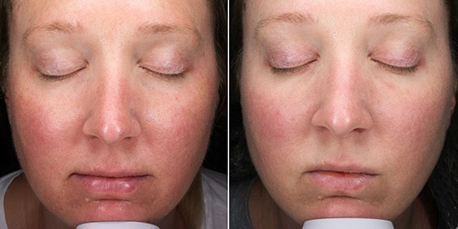 hydrafacial-microneedling-2 hydrafacial microneedling