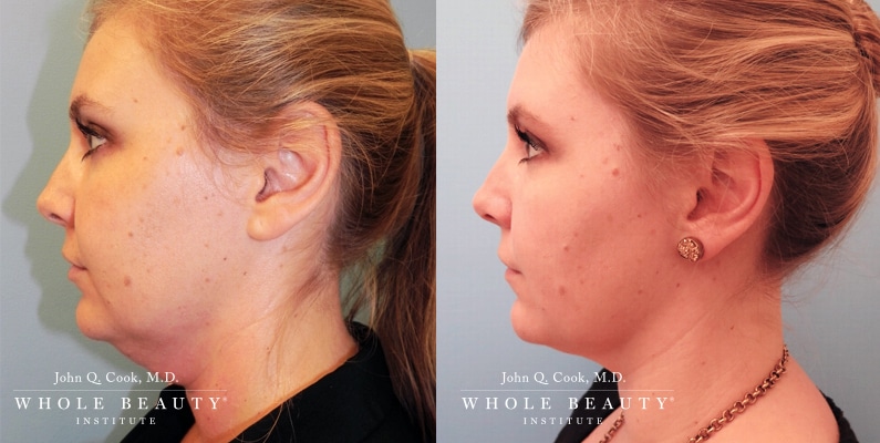 kybella kybella