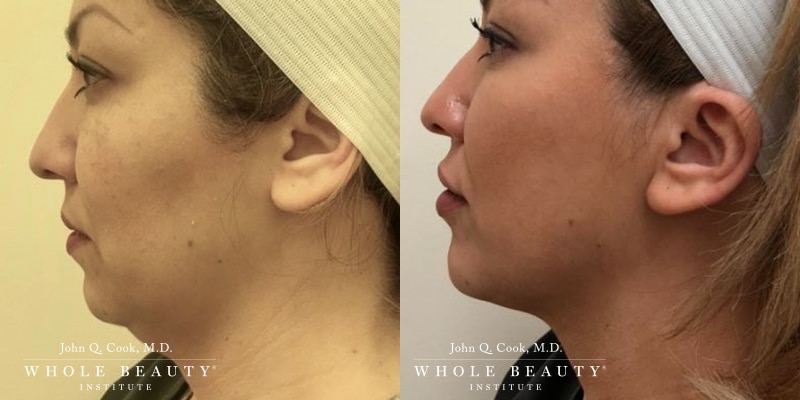 kybella kybella gigi