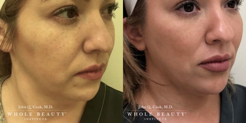 kybella kybella gigi