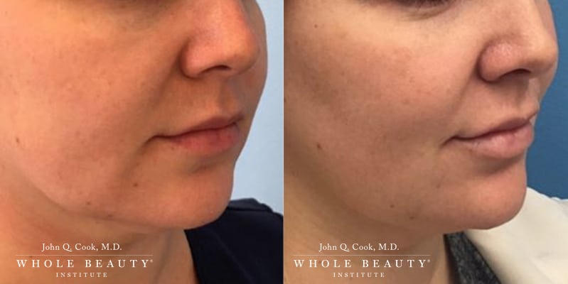 kybella kybella meade