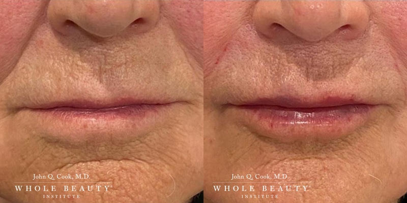 lip-filler-2 lip filler