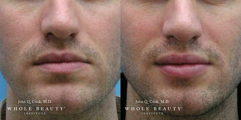 lip-filler lip filler justin