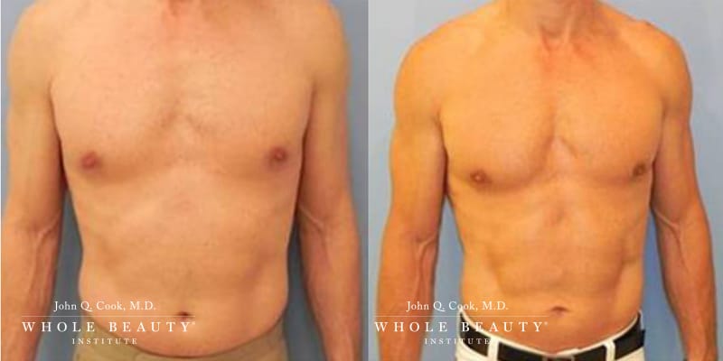 slimlipo-men-1 slimlipo men