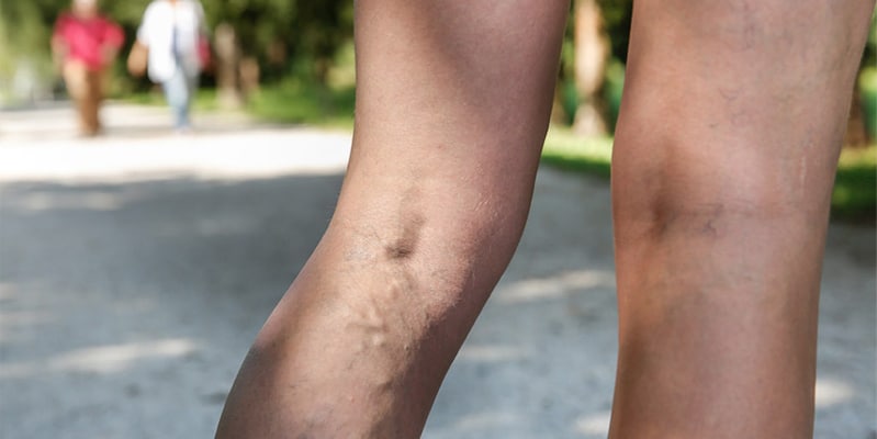vein-removal vein removal