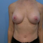 Breast Augmentation Case 7 After