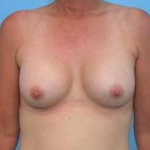 Breast Augmentation Case 9 After