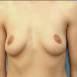 Breast Augmentation Case 10 Before