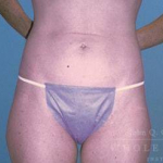 Liposuction Case 1 Before