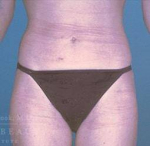 Liposuction Case 1 After