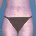 Liposuction Case 1 After