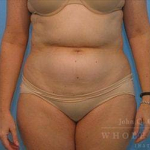 Liposuction Case 2 Before