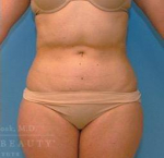 Liposuction Case 2 After