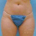 Liposuction Case 3 Before