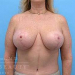 Abdominoplasty (tummy tuck) Case 2 After