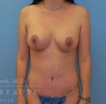 Abdominoplasty (tummy tuck) Case 6 After