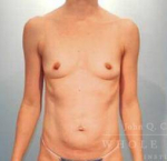 Abdominoplasty (tummy tuck) Case 8 Before