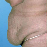 Abdominoplasty (tummy tuck) Case 10 Before