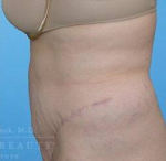 Abdominoplasty (tummy tuck) Case 10 After