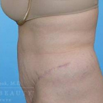 Abdominoplasty (tummy tuck) Case 10 After