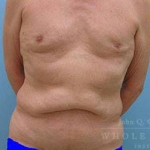 Abdominoplasty (tummy tuck) Case 13 Before
